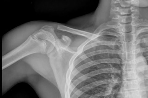 Складні переломи плеча: різновиди травм і можливі ускладнення
