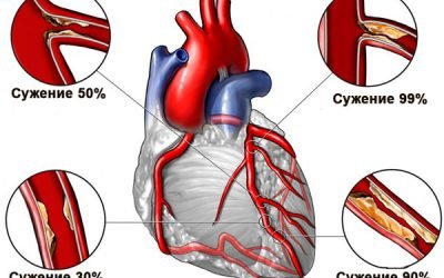 Колючий біль в області серця: що робити і які причини