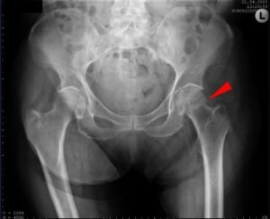 Наскільки небезпечний субкапітальний перелом шийки стегна, з яких причин виникає, симптоми і лікування