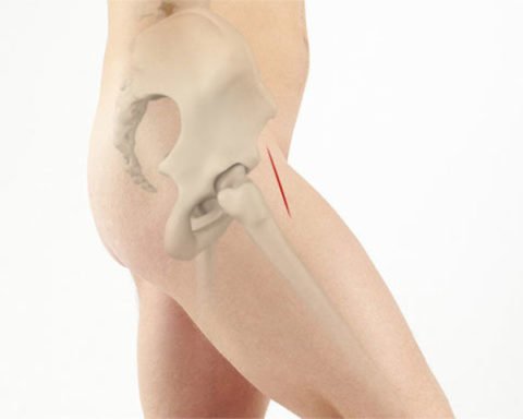 Протезування при переломі шийки стегна: особливості процедури, види операцій і терміни реабілітації