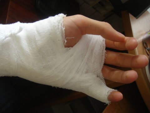 Перелом мізинця на руці зі зміщенням: терміни зрощення кістки, загальний прогноз реабілітаційного періоду