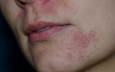 Пероральний дерматит на обличчі: лікування маззю у дорослих і дитини, причини, як лікувати?