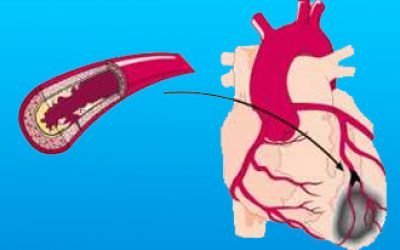 Чим відрізняється інфаркт від інсульту: у чому різниця і що небезпечніше?