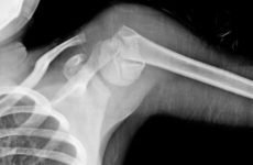 Наслідки перелому плеча – причини, симптоматика та способи боротьби