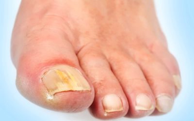 Як лікувати грибок на великому пальці ноги