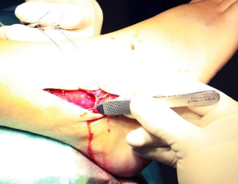 Операція при переломі гомілки – особливості будови суглоба, походження отриманих травм і хірургічні методи лікування