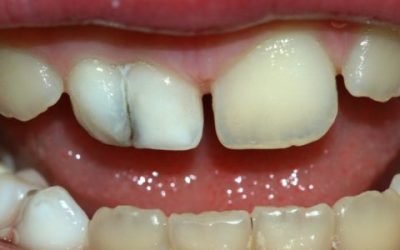 Як відбуваються вивихи і переломи зубів, яке лікування призначається при цих травмах