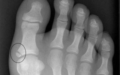 Як відрізнити забій пальця від перелому: спільні та відмінні характеристики, особливості діагностики та першої медичної допомоги