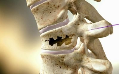 Як проходить лікування компресійного перелому хребта