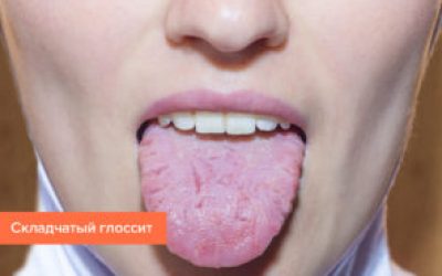 Рана на язиці: як лікувати і чим, причини порізів мовою, ефективні препарати і народні засоби лікування мовних травм
