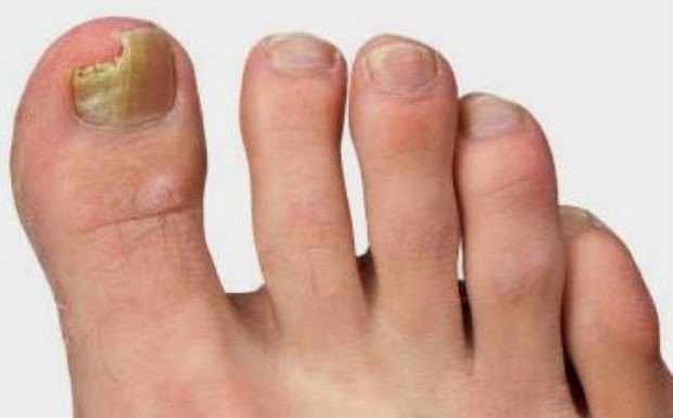 Грибок нігтя на великому пальці ноги: лікування, видалення і симптоми