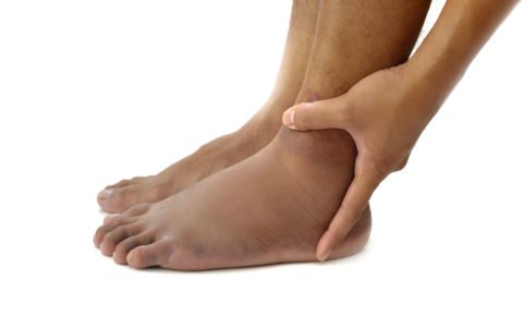 Як зняти набряк ноги після перелому – препарати та народні засоби