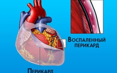 Симптоми і лікування рідини в серці