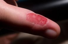 Опік пальця: різновиди травми, перша допомога, лікування