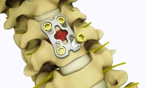 Лікування компресійного перелому поперекового відділу хребта: всі методи