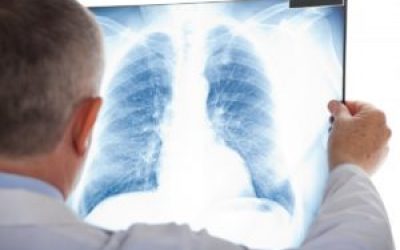 Може бути запалення легень без температури і кашлю: як розпізнати?