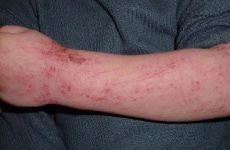 Атопічний дерматит на руках у дорослих і дітей: чим лікувати і як запобігти