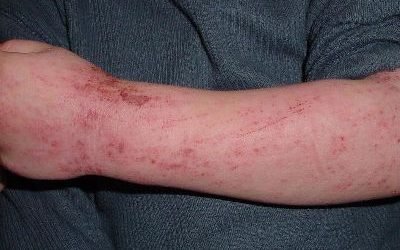 Атопічний дерматит на руках у дорослих і дітей: чим лікувати і як запобігти