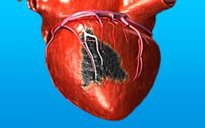 Дієта і харчування після інфаркту міокарда для чоловіків і жінок