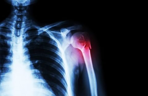 Лікування закритого перелому плеча в залежності від типу травми і області ушкодження