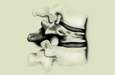 Як виглядає компресійний перелом хребта 1 ступеня