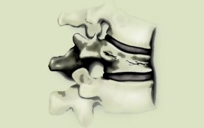 Як виглядає компресійний перелом хребта 1 ступеня