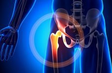 Перелом сідничної кістки — особливості травми, симптоми і лікування