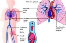 Лікування і профілактика тромбоемболії легеневої артерії