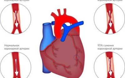 Тупий ниючий біль в області серця: дискомфорт і тяжкість в грудній клітці