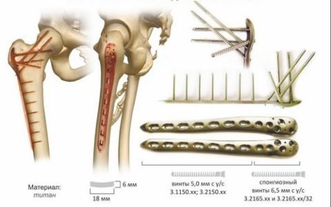 Остеосинтез при переломі шийки стегна: як проходить операція