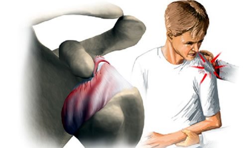 Осколковий перелом плечової кістки: анатомічні особливості травми, симптоматика, діагностика, перша допомога і лікування