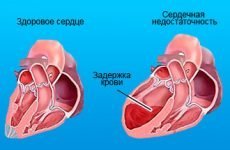 Серцево-легенева недостатність: симптоми, класифікація і лікування