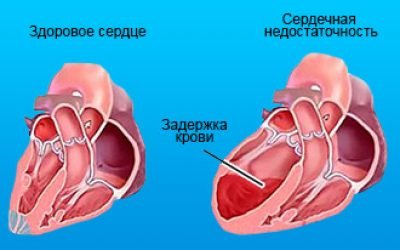 Серцево-легенева недостатність: симптоми, класифікація і лікування