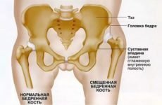Перелом і вивих кульшового суглоба: особливості травм їх види і методи лікування