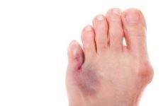 Перелом пальців ноги – причини, класифікація, симптоматика, діагностика і лікування