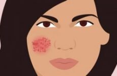 Екзема на обличчі: симптоми, причини і лікування
