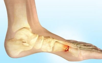 Симптоми перелому стопи – класифікація травми, характерні ознаки та варіанти ефективного відновлення