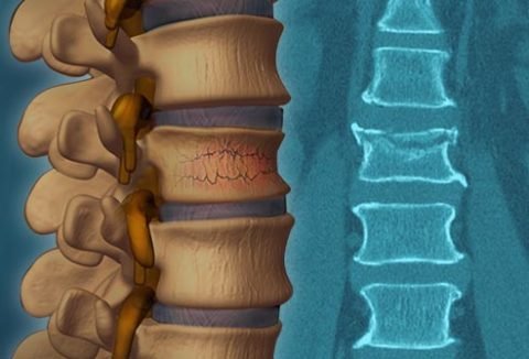 Якими симптомами проявляється компресійний перелом шийного відділу хребта, причини виникнення, методи діагностики та лікування