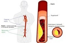 Ущільнення або атеросклероз аорти серця: симптоми і лікування клапана і стінок
