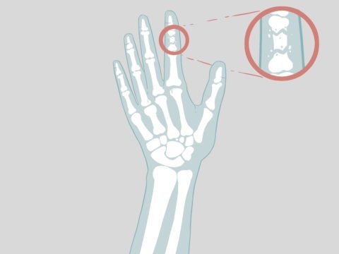 Як визначити перелом вказівного пальця руки — причини, симптоми і лікування