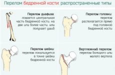 Класифікація переломів стегна: види травм та їх особливості