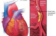 Біль при інфаркті міокарда: що робити і скільки триває