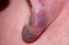 Обмороження вух: симптоми і ступеня, перша допомога та лікування травми