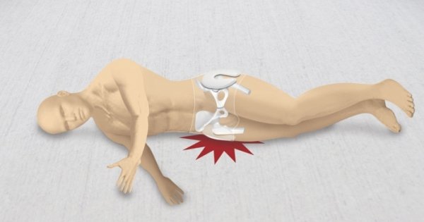 Перелом стегна: симптоми та невідкладна допомога при відкритому переломі стегна