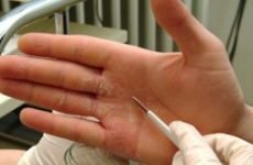 Холодова екзема на руках: причини, симптоми і лікування. Як і чим лікувати екзему від холоду на руках взимку