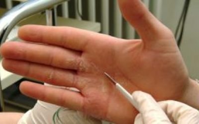 Холодова екзема на руках: причини, симптоми і лікування. Як і чим лікувати екзему від холоду на руках взимку