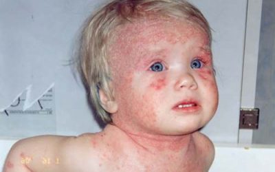 Атопічний дерматит у дітей: лікування, симптоми та причини
