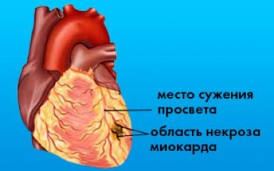 Дрібновогнищевий інфаркт міокарда на ЕКГ