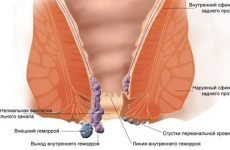 Тромбоз гемороїдального вузла: стадії і методи лікування захворювання