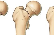 Ускладнення при переломах шийки стегна: чим небезпечні подібні травми і як уникнути неприємних наслідків